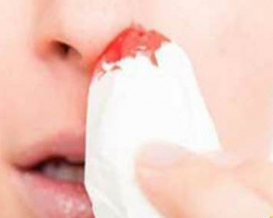 流鼻血的時候，別再傻傻地用衛(wèi)生紙堵鼻子了！